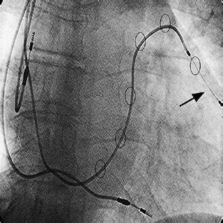 transthoracic epicardial lead insert